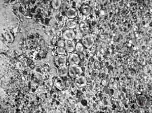 F, 45y. | necrobiosis lipoidica F, 45y. | necrobiosis lipoidica